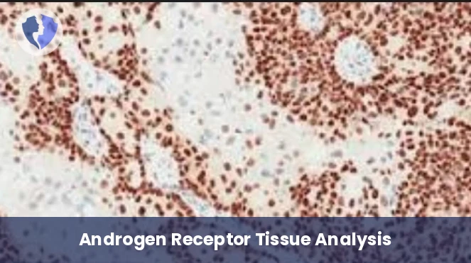 Androgen Receptor (AR) Test - Immunohistochemistry: Androgen Receptor (AR)