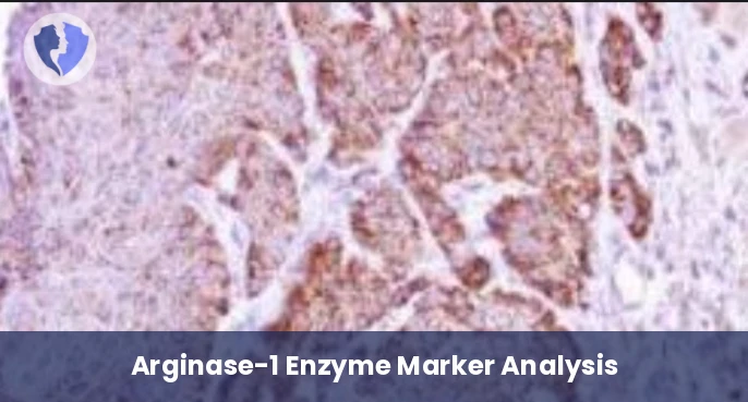 Arginase-1 Liver Cancer Test - Immunohistochemistry: Arginase-1