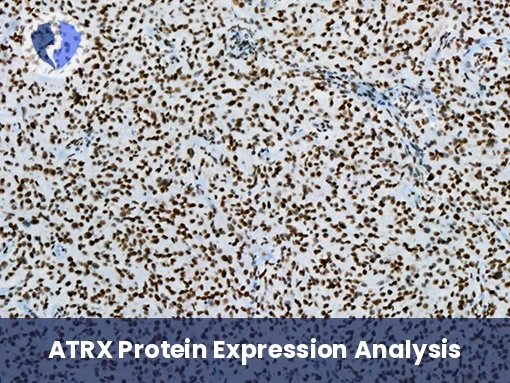 ATRX Brain Tumor Diagnosis - Immunohistochemistry: ATRX Test