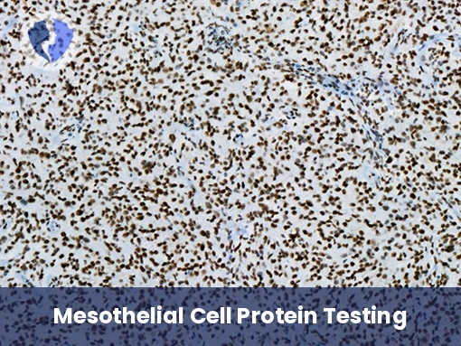 Calretinin Mesothelioma Diagnosis - Immunohistochemistry: Calretinin Test