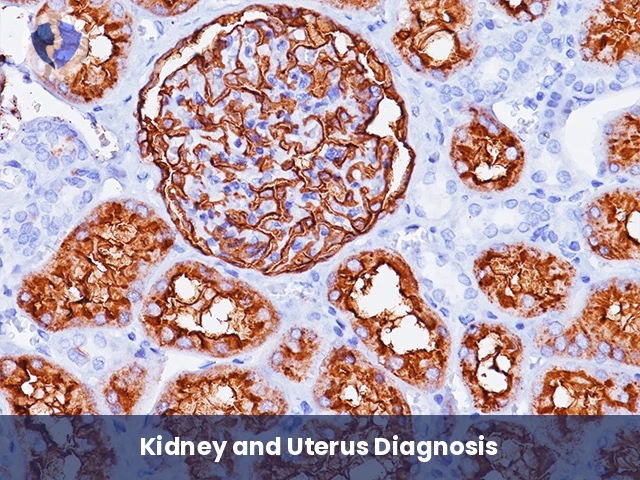 Kidney & Uterine Tumor Package - Immunohistochemistry: CD10 Diagnostic Package