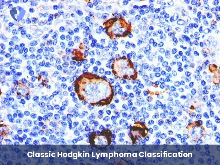 Hodgkin Lymphoma Diagnostic Package - Immunohistochemistry: CD15 Diagnostic Package