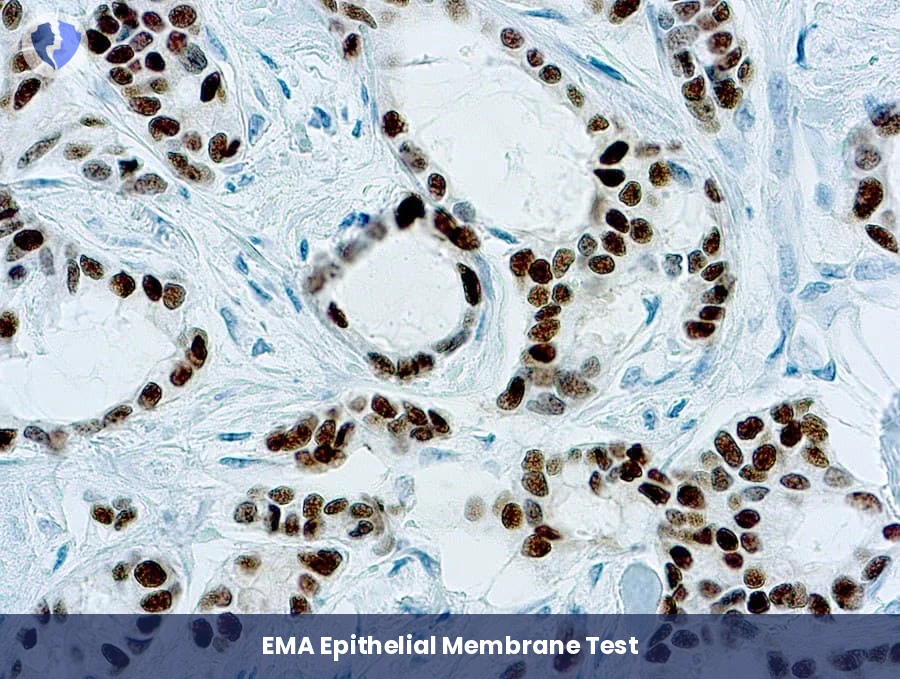 EMA Marker for Tumor Classification - Immunohistochemistry: Epithelial Membrane Antigen (EMA)