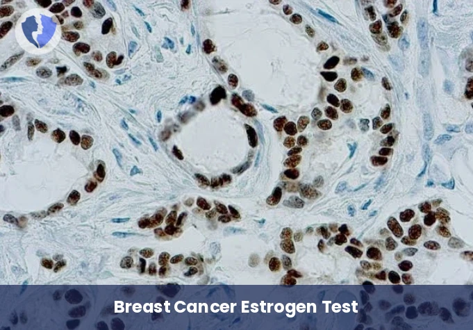 Estrogen Receptor Test for Breast Cancer - Immunohistochemistry: Estrogen Receptor (ER)
