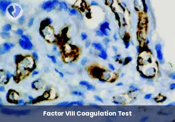 Factor VIII Test for Vascular Tumors - Immunohistochemistry: Factor VIII