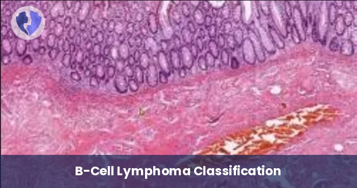 Lymphoma Diagnostic Screening - Immunohistochemistry (IHC): CD5
