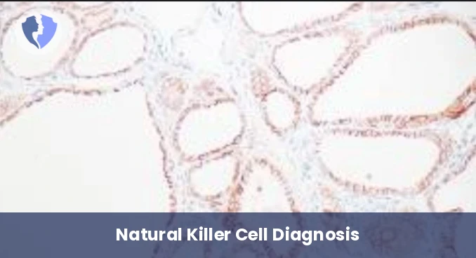 Natural Killer Cell Tumor Test - Immunohistochemistry (IHC): CD56 (Natural Killer Cells)