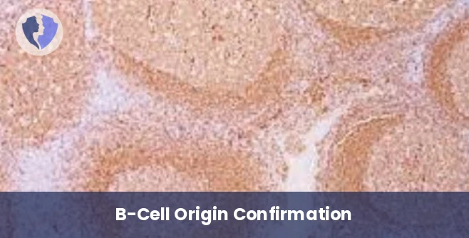 B-Cell Tumor Diagnosis - Immunohistochemistry (IHC): CD79A