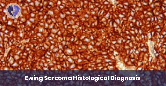 Bone and Soft Tissue Diagnosis - Immunohistochemistry (IHC): CD99