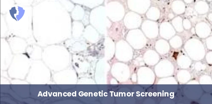 Fatty Tissue Tumor Screening - Immunohistochemistry (IHC): CDK4