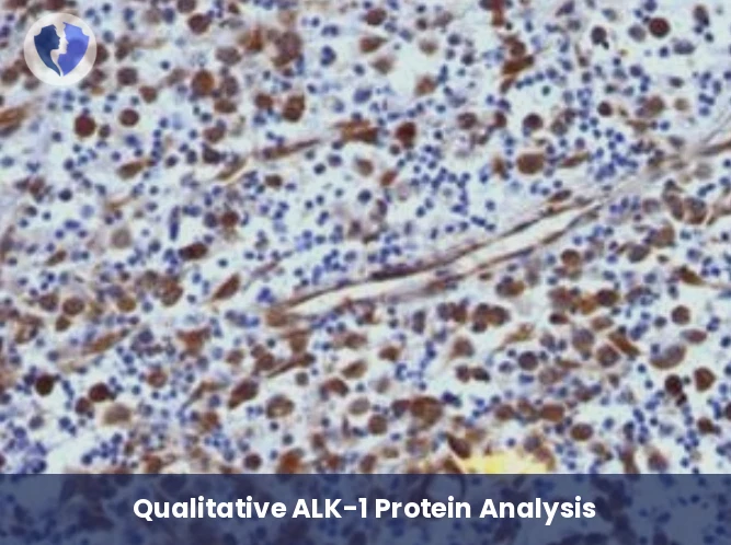 ALK-1 Protein Tumor Analysis - Immunohistochemistry (IHC) for ALK-1 Protein