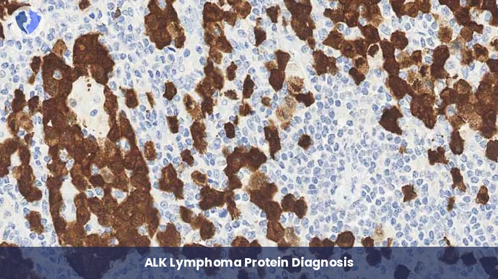 ALK Protein Test for Lymphoma - Immunohistochemistry (IHC) for ALK Lymphoma