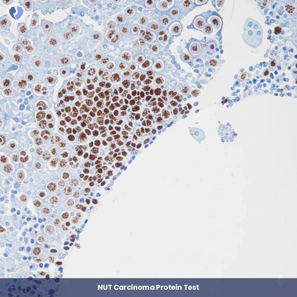 Diagnosing Aggressive NUT Carcinoma - Immunohistochemistry (IHC) for NUT