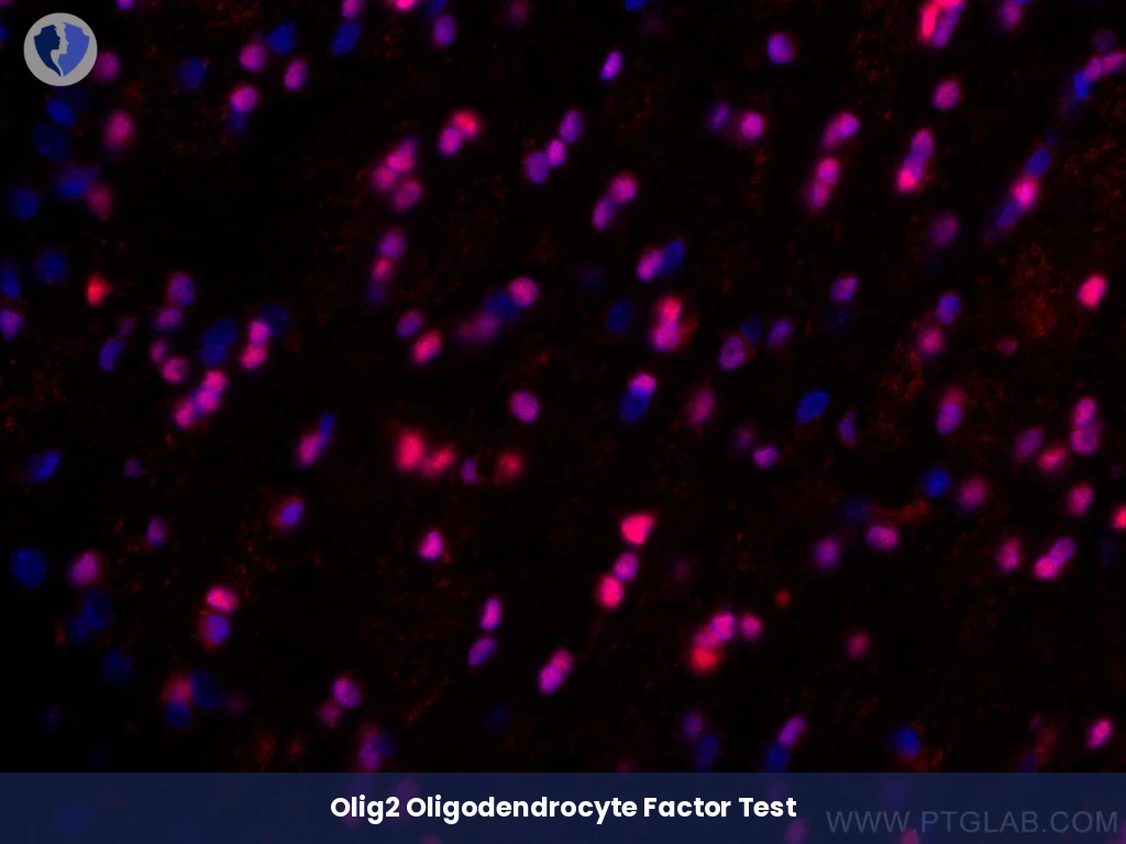 Classifying Glial Brain Tumors - Immunohistochemistry (IHC) for Olig2