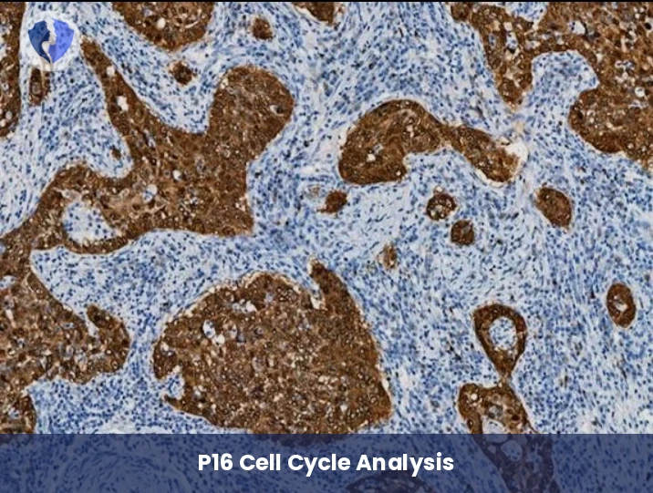 HPV and Cervical Cancer Screening - Immunohistochemistry (IHC) for P16