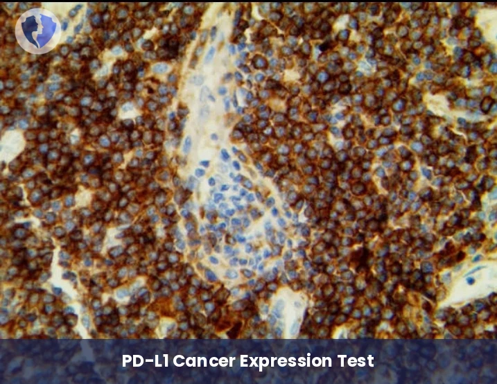 PD-L1 Immunotherapy Response Test - Immunohistochemistry (IHC) for PD-L1