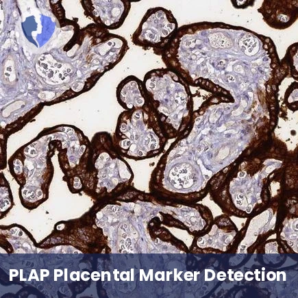 PLAP Germ Cell Tumor Test - Immunohistochemistry (IHC) for Placental Alkaline Phosphatase (PLAP)