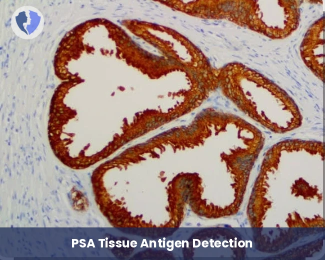 PSA Tissue Confirmation Test - Immunohistochemistry (IHC) for Prostate-Specific Antigen (PSA)