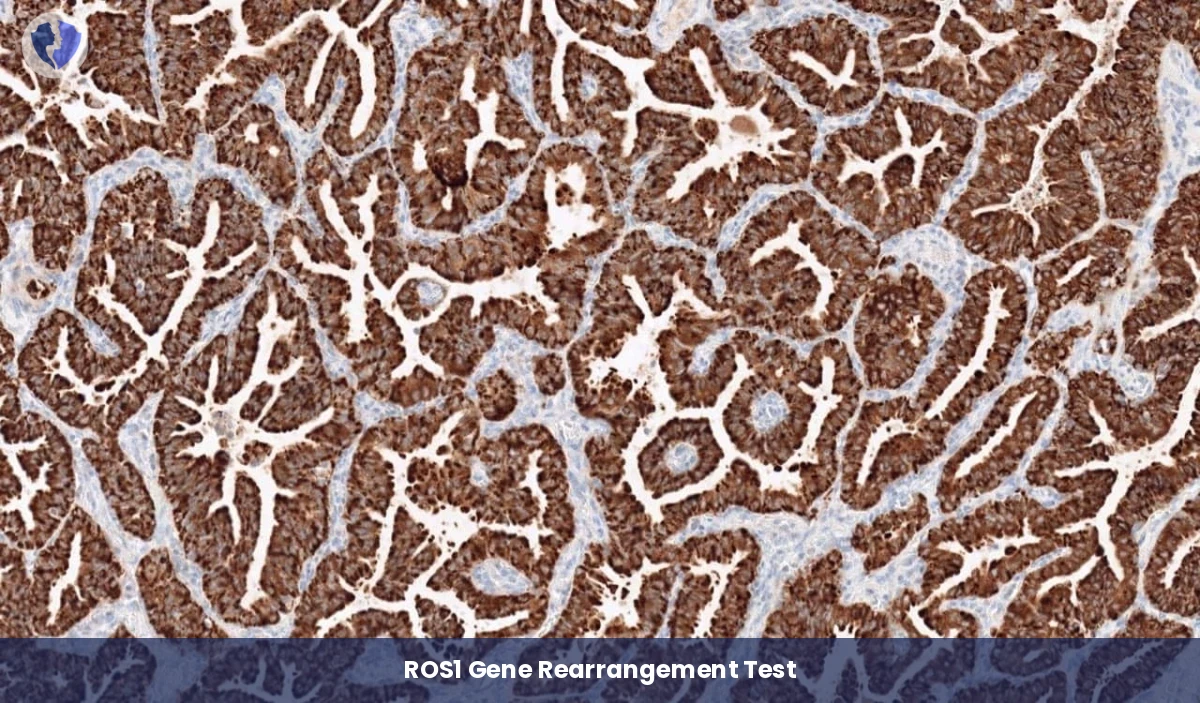 ROS1 Targeted Therapy Test - Immunohistochemistry (IHC) for ROS1