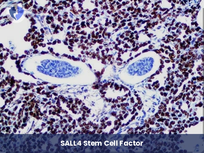 Germ Cell Tumor Diagnosis - Immunohistochemistry (IHC) for SALL4
