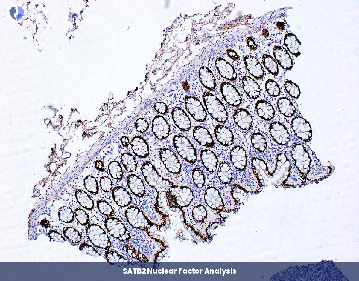 Colorectal Cancer Source Identification - Immunohistochemistry (IHC) for SATB2
