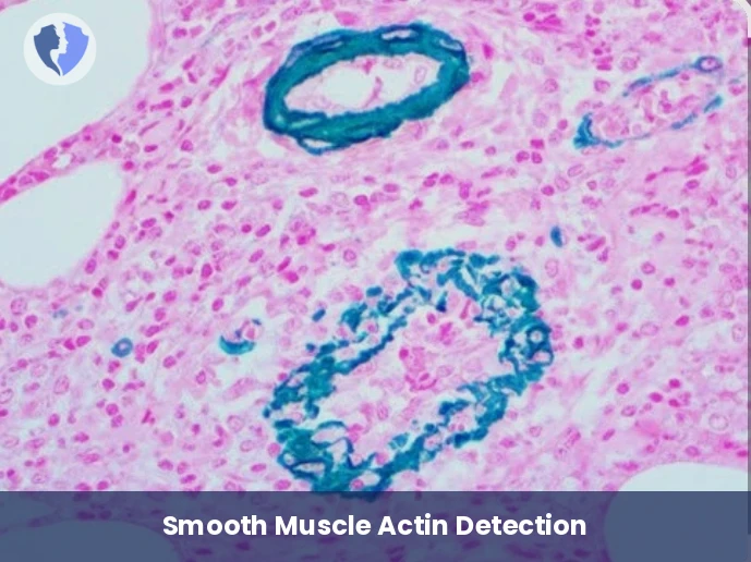 Smooth Muscle Tumor Detection - Immunohistochemistry (IHC) for Smooth Muscle Actin (SMA)