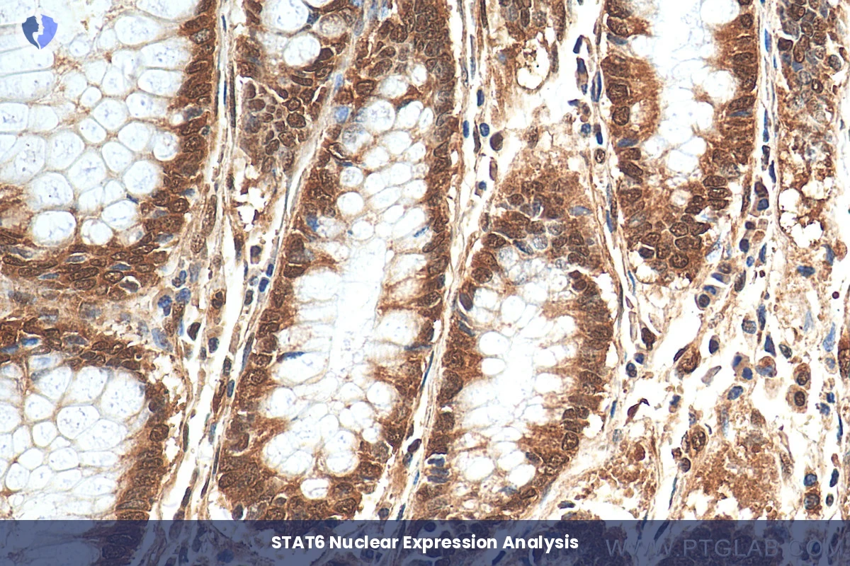 Solitary Fibrous Tumor Diagnosis - Immunohistochemistry (IHC) for STAT6