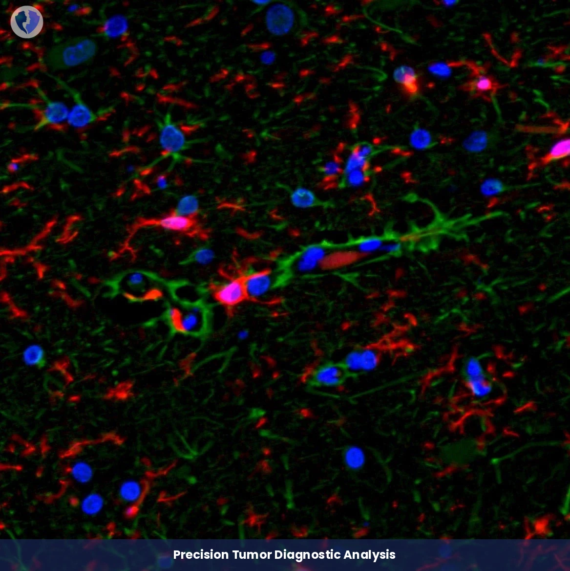 Accurate Classification & Risk Assessment - Immunohistochemistry (IHC) Interpretation and Consultation (4 Mark