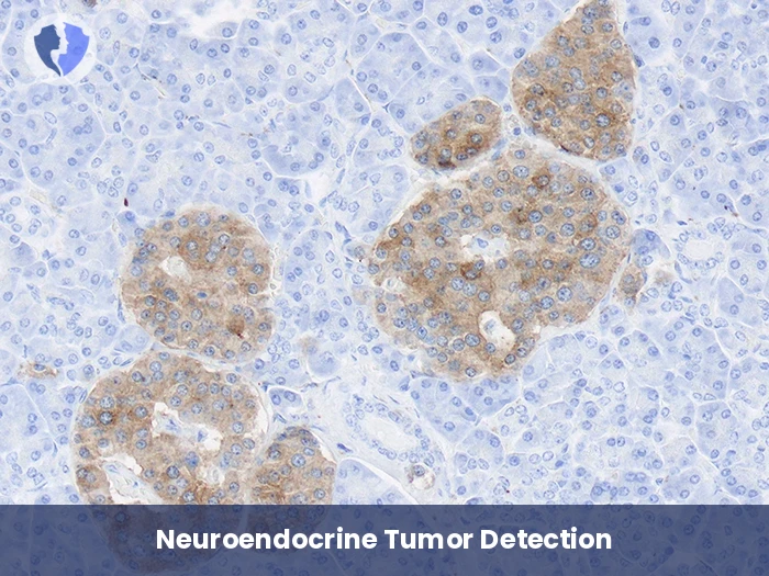 Neuroendocrine Tumor Diagnosis - Immunohistochemistry: Synaptophysin