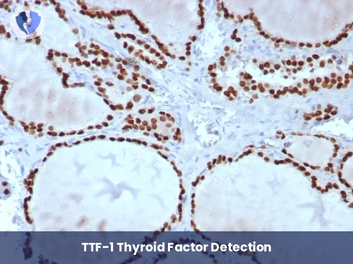 Lung and Thyroid Source ID - Immunohistochemistry: TTF-1