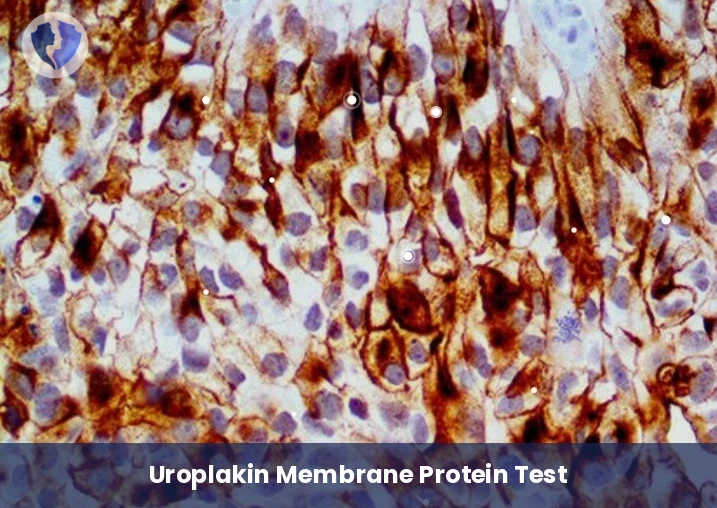 Urological Tumor Detection - Immunohistochemistry: Uroplakin