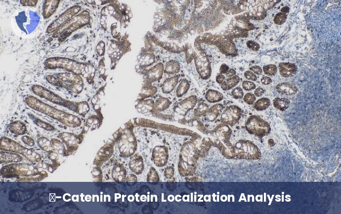 Detecting Genetic Defects in Tumors - Immunohistochemistry: β-Catenin