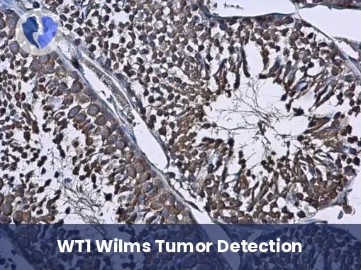 Ovarian and Kidney Tumor Diagnosis - Immunohistochemistry: Wilms Tumor Protein (WT1)