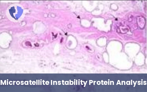 MSI Cancer Immunotherapy Screening - Microsatellite Instability (MSI) Test