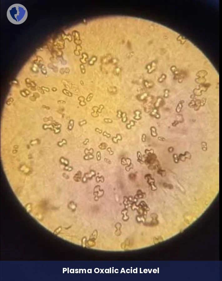 Plasma Oxalate Level Test - Plasma Oxalic Acid (Oxalate) Test