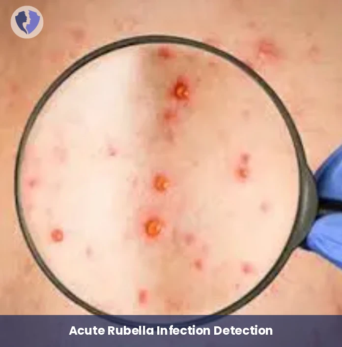 Acute Rubella Infection Test - Rubella IgM Antibody Test