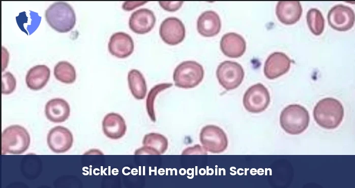 Sickle Cell Screen Test