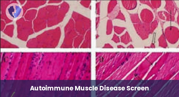 Skeletal Muscle Antibodies Test - Skeletal Muscle Antibodies (ABS) Test