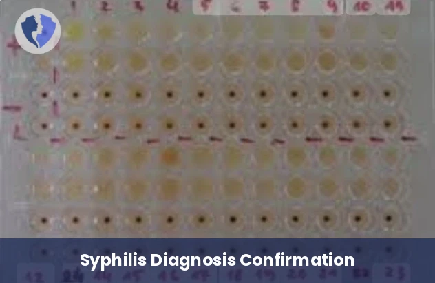 Treponema Pallidum Hemagglutination Assay (TPHA)