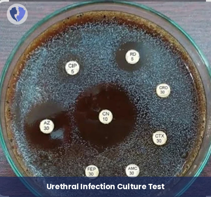Urethral Discharge Culture Test - Urethral Discharge Culture and Sensitivity