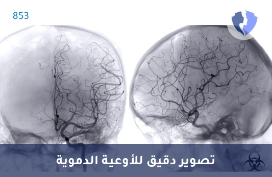 تصوير الأوعية الدموية بالمقطعية - أشعة مقطعية لتصوير الأوعية الدموية (CTA)
