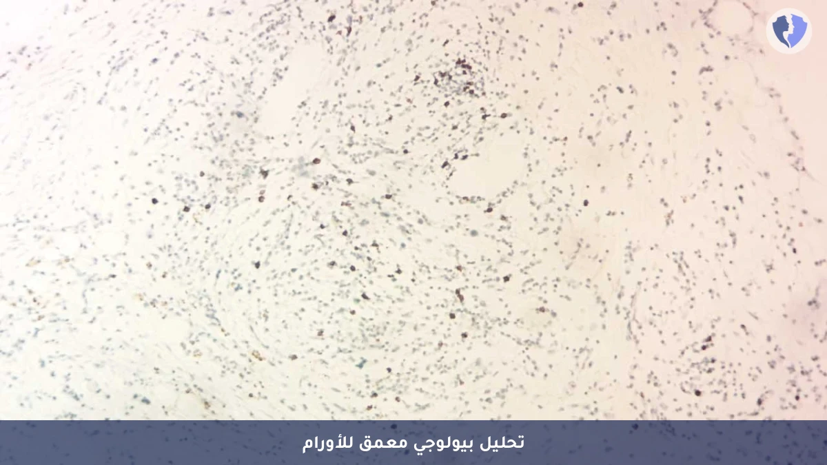 تحليل بحثي لخصائص الورم - استشارة وتفسير نتائج الكيمياء النسيجية المناعية - 13 علامة (13 Markers)