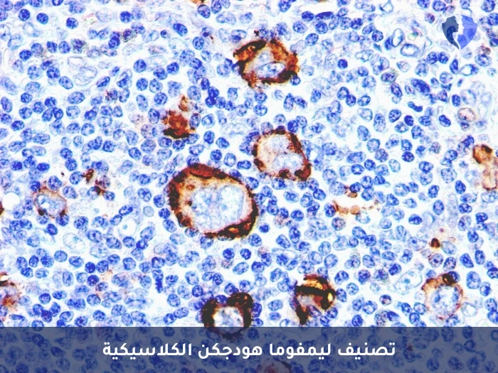 باقة تشخيص لمفوما هودجكين - باقة تحليل الكيمياء النسيجية المناعية (CD15)