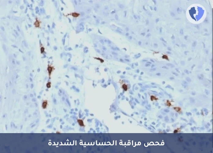 فحص مؤشر الحساسية المفرطة - تحليل إنزيم التريبتيز (Tryptase)