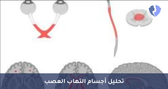 تشخيص التهاب العصب البصري - تحليل الأجسام المضادة لالتهاب العصب البصري والنخاع (NMO IgG)