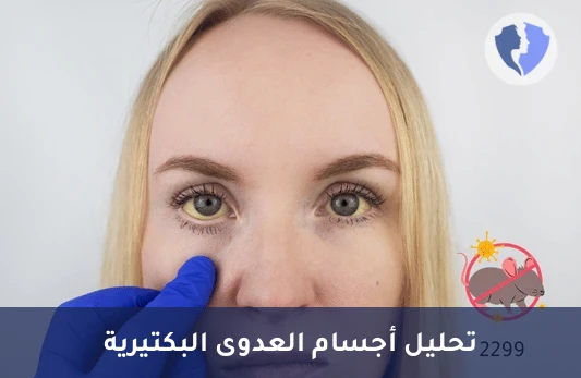 تحليل بكتيريا داء البريميات - تحليل الأجسام المضادة لداء البريميات (Leptospirosis Serology)