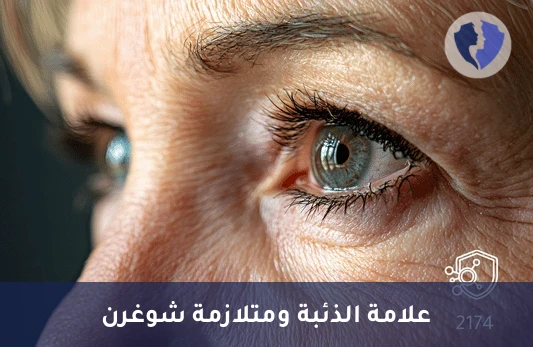 فحص الذئبة وجفاف العين - تحليل الأجسام المضادة لـ (Anti Ro/SS-A)