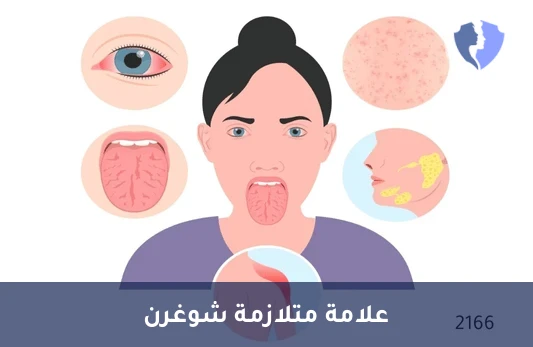 فحص متلازمة شوغرن - تحليل الأجسام المضادة لـ لا (Anti La SS-B Abs)