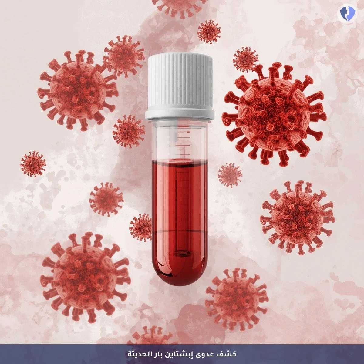تشخيص عدوى إبشتاين-بار الحادة - تحليل الأجسام المضادة لفيروس إبشتاين بار (EBV VCA IgM)