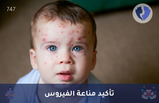 فحص مناعة الجدري المائي IgG - تحليل الأجسام المضادة لفيروس الجدري المائي (Varicella Zoster IgG)